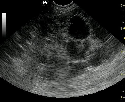 Liver lobe torsion, severe, diffuse, subacute necrohemorrhagic liver ...