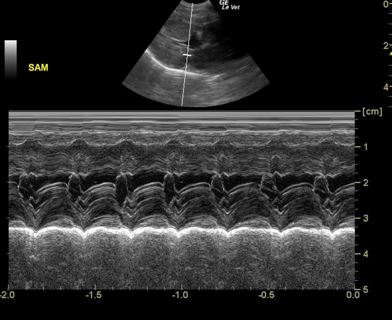 Mild systolic anterior motion (SAM) of the mitral valve in a 19 year ...