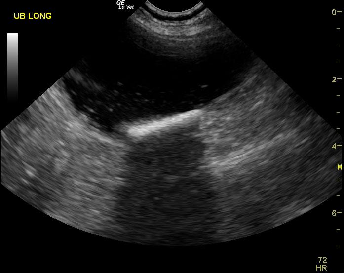 06-00069 Cody R Tcc Of Prostate And Urethra. Bilat Hydronephrosis-needs 