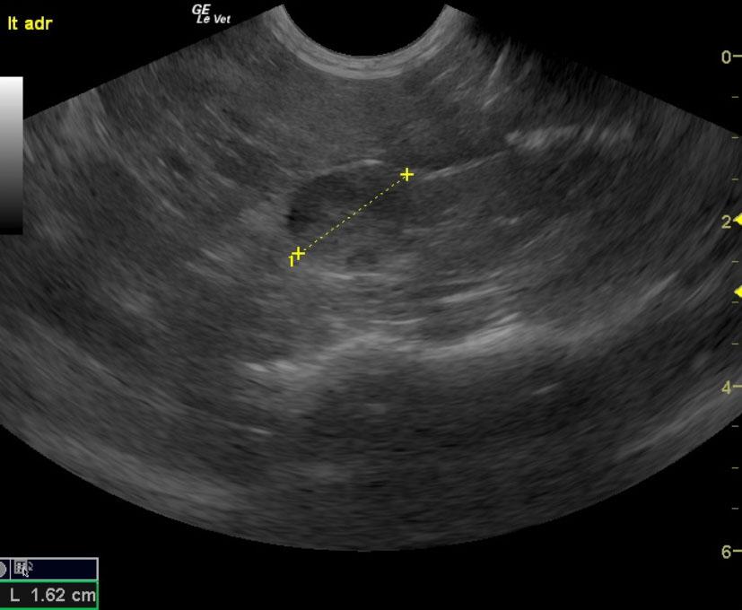 Bilateral adrenal masses with mineralization of the right adrenal in a ...