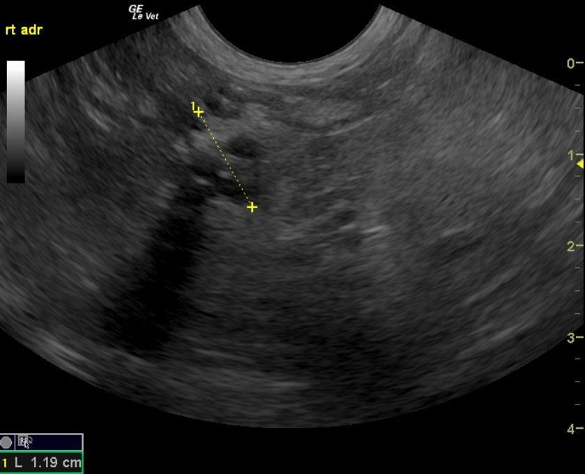 Bilateral adrenal masses with mineralization of the right adrenal in a ...