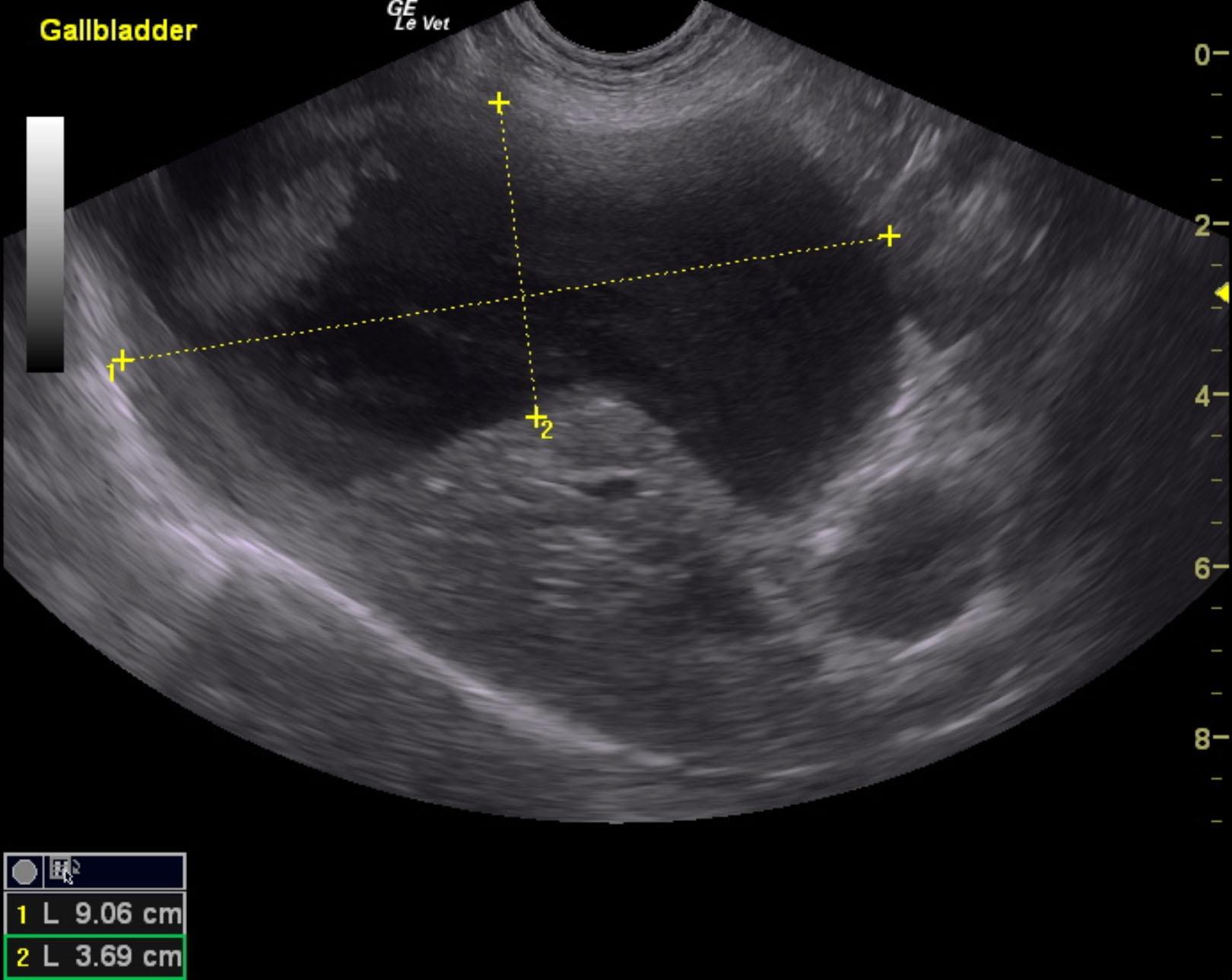 Extra-hepatic bile duct obstruction from mass at duodenal papilla in an ...