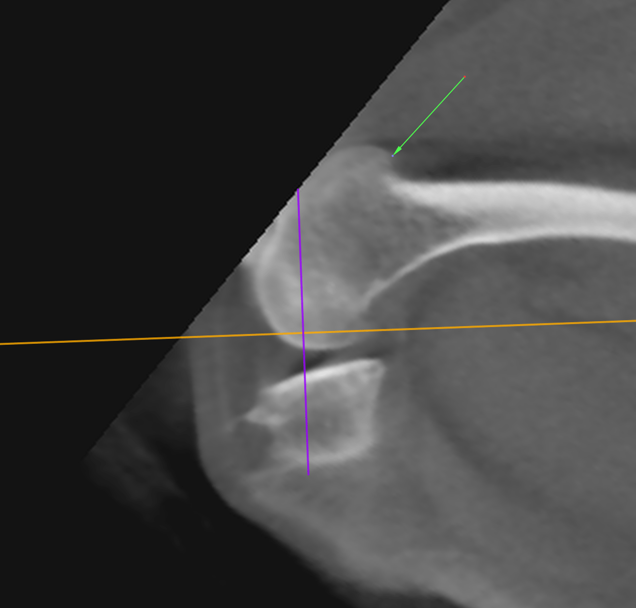 CT Degenerative Joint Disease of the Stifle and Vertebral Malformation