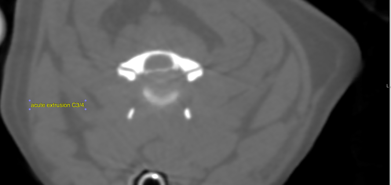 CT Cervical Disc Herniation Multiple Sites with Compressive
