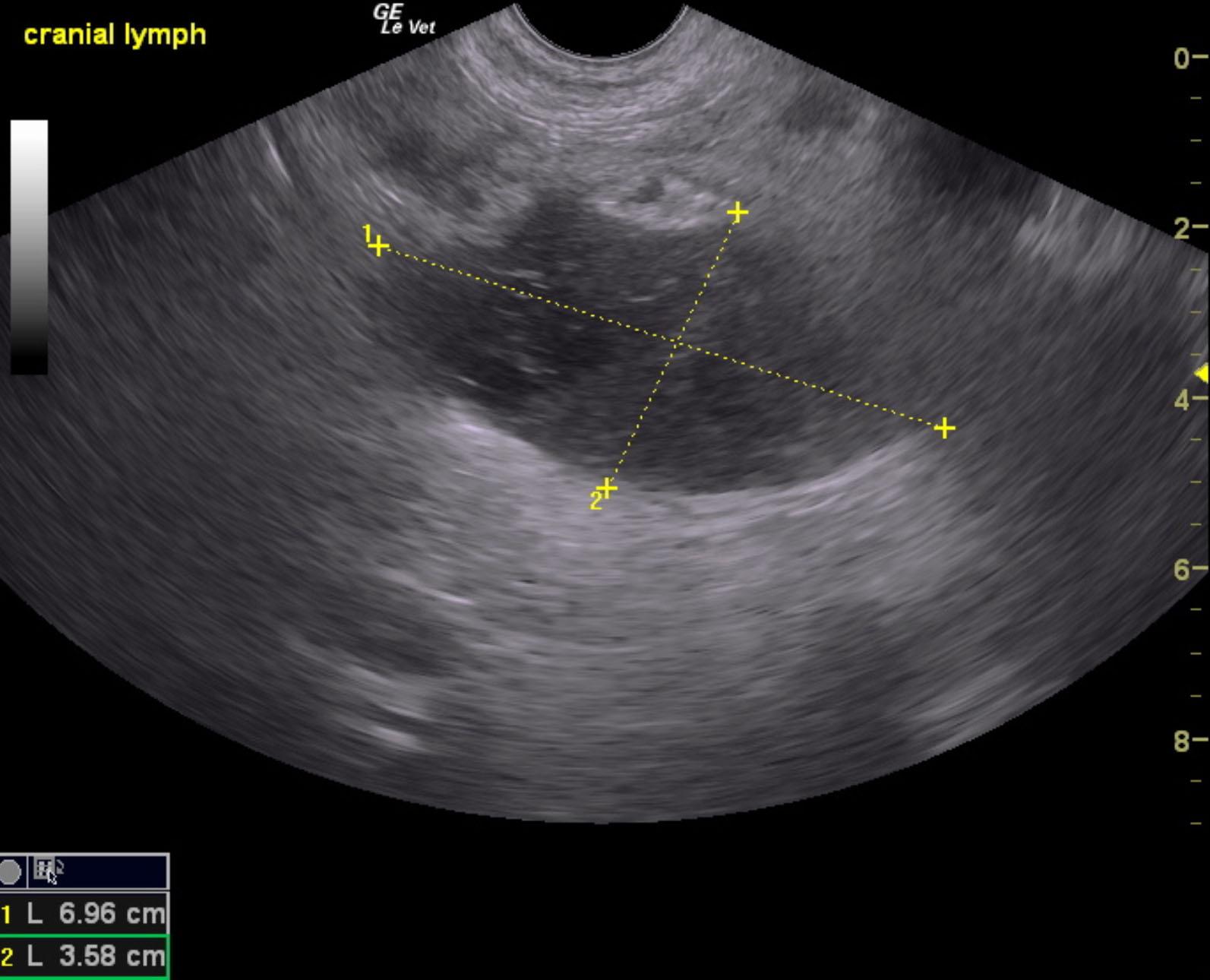 Intestinal necrosis and peritonitis with mineralized omental hematoma ...