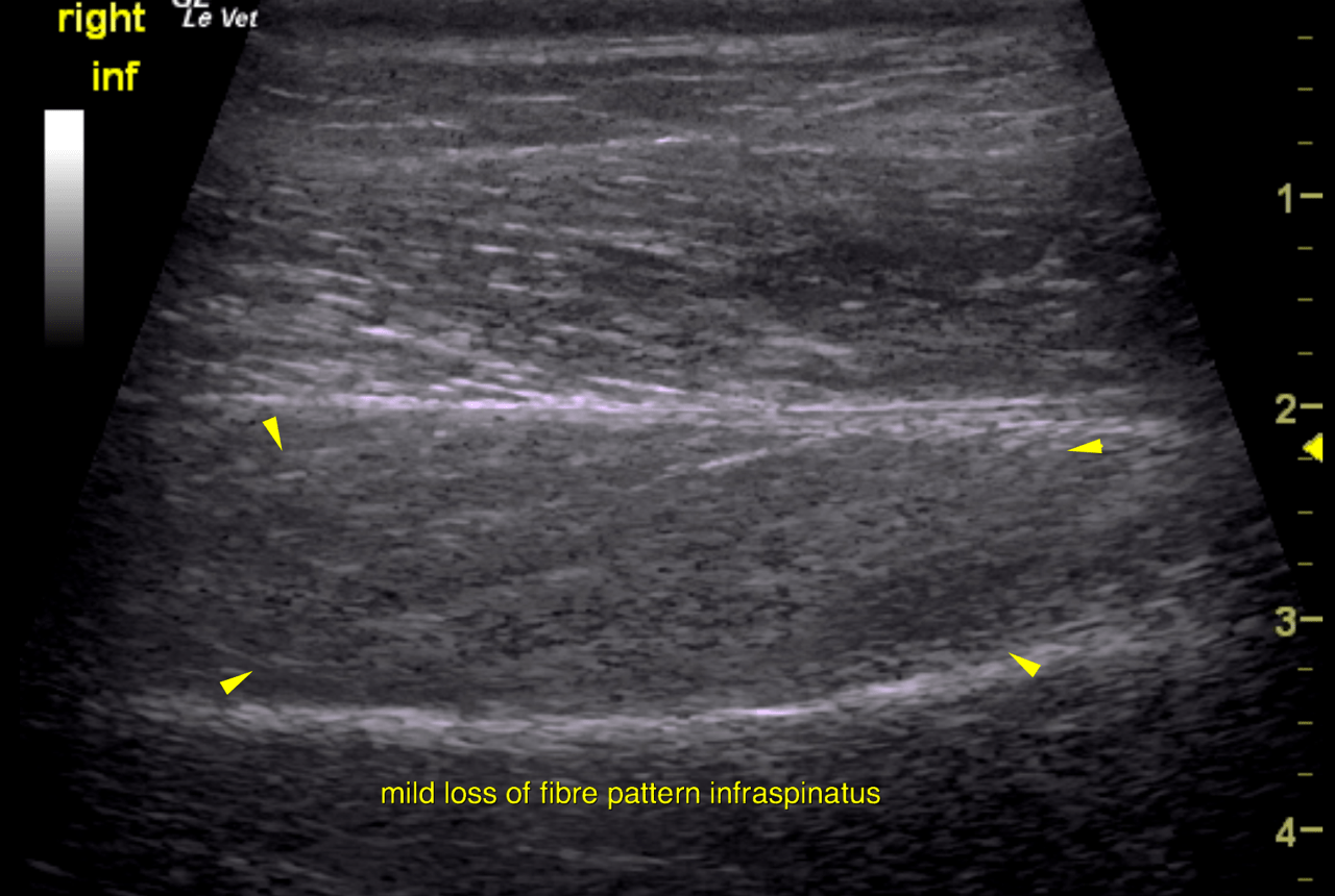 ORTHO - Chronic biceps tendinopathy and tenosynovitis with ...