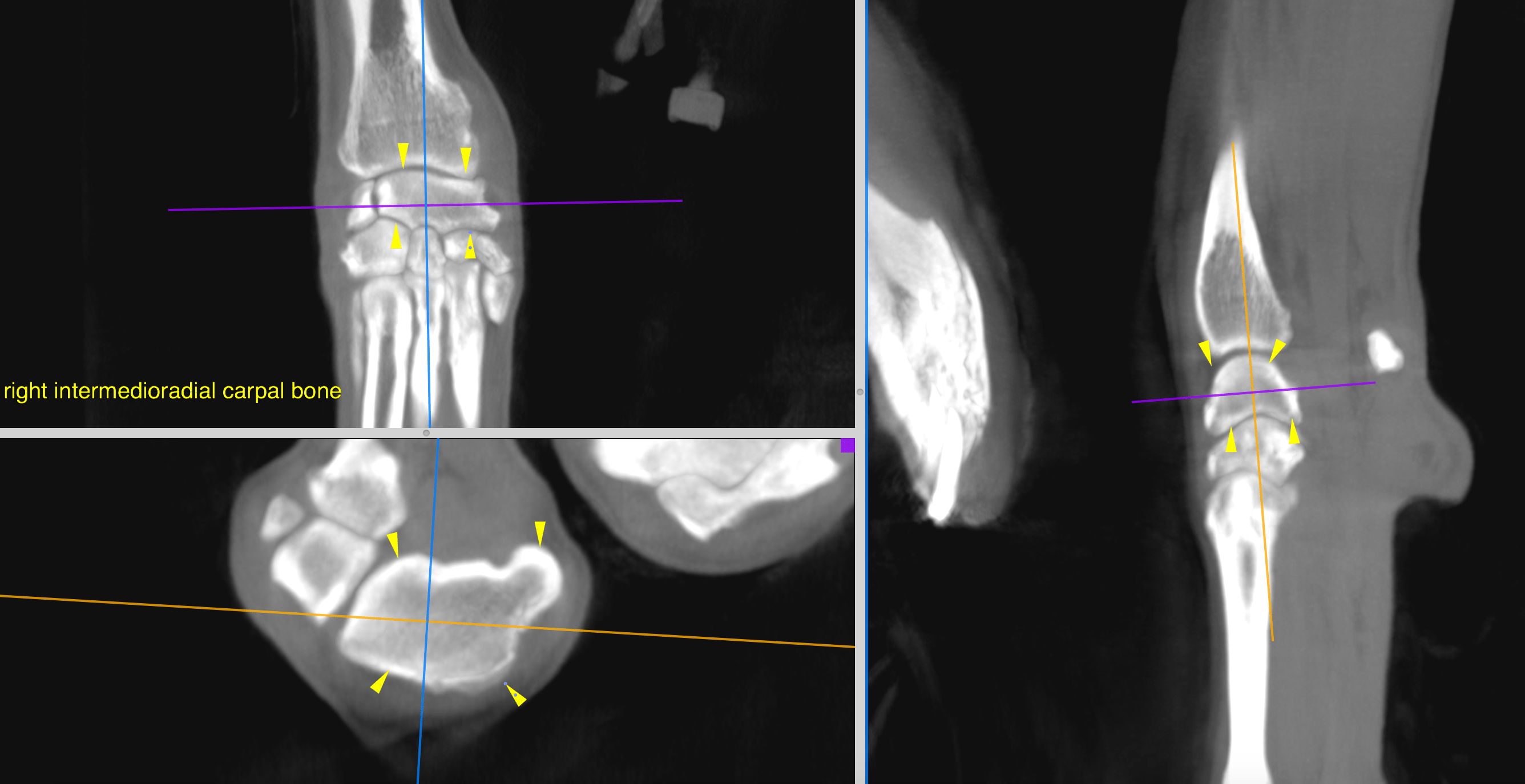 CT- bilateral fragmentation of the medial coronoid process with ...