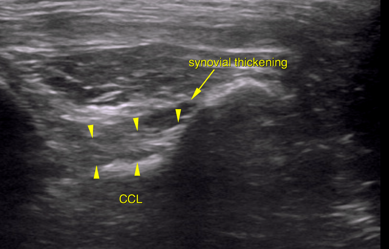 ORTHO - Calcifying tendinopathy of the supraspinatus muscle and ...