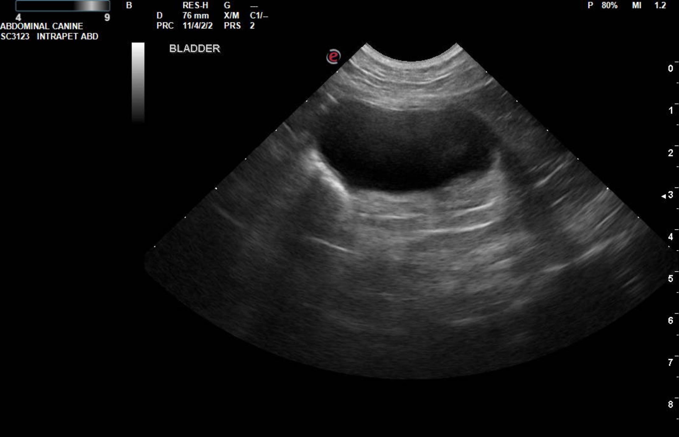 Ureteral calculus at the level of the ureteral papillae and minor ...