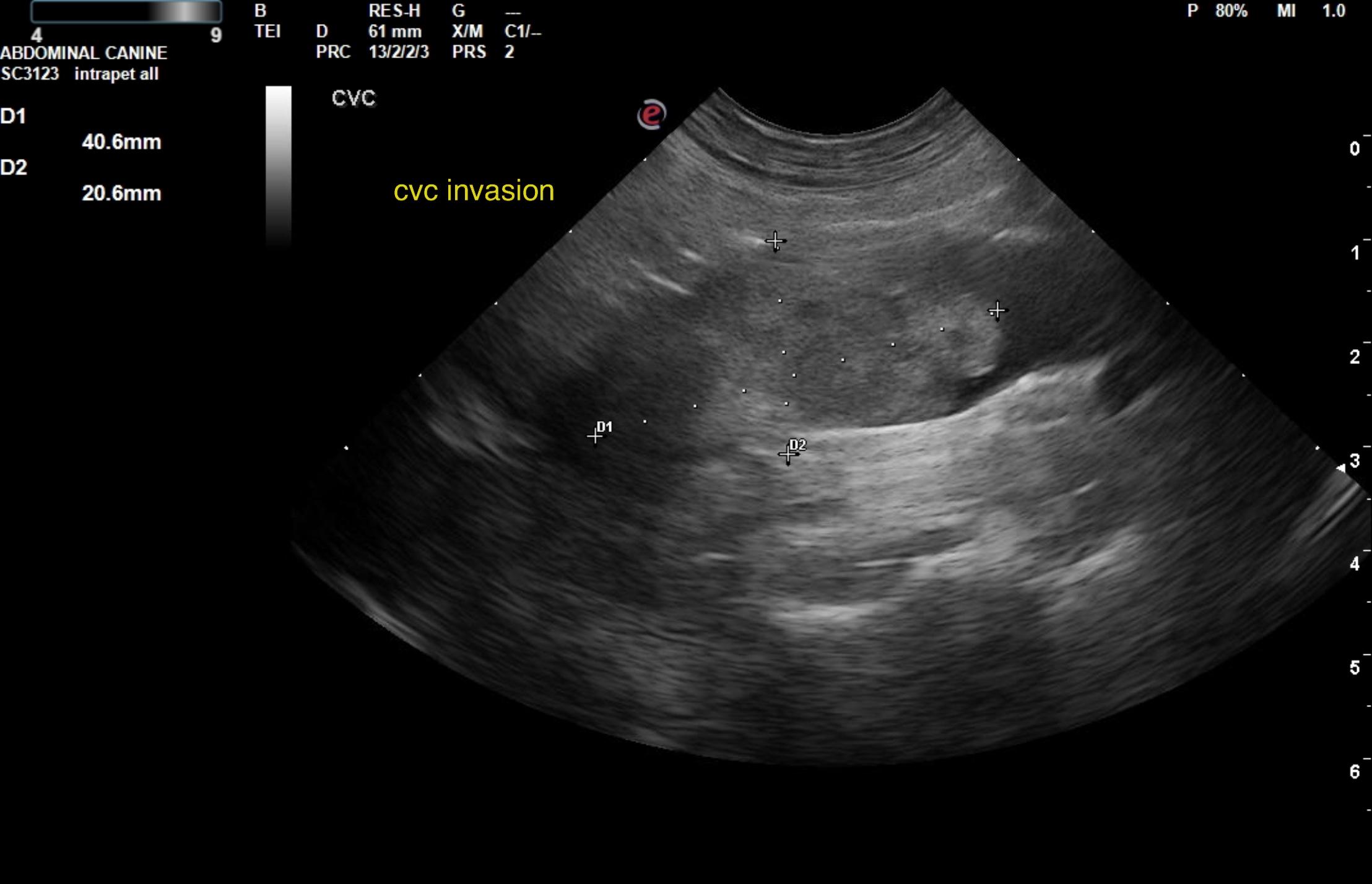 Left adrenal mass with phrenic vein and vena caval invasion in a 13 ...