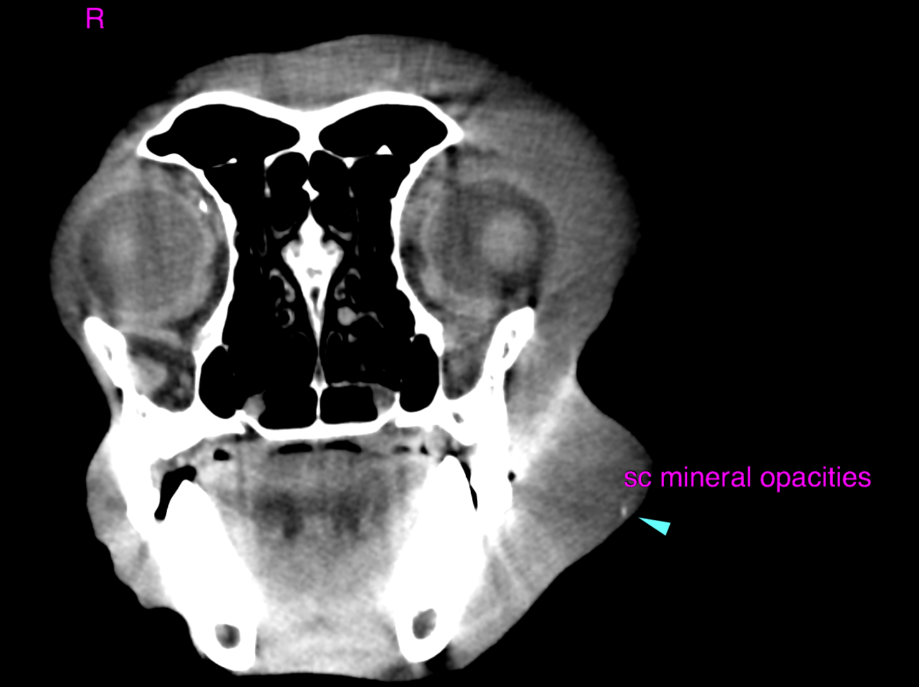 CT - Facial abscess with septic cellulitis and lymphadenitis in a 7 ...