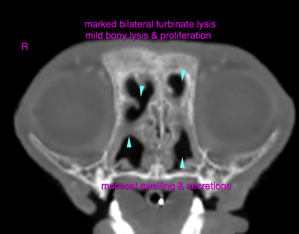 Bilateral Rhinitis CT - Bilateral destructive rhinitis with lymphadenitis, chronic ...