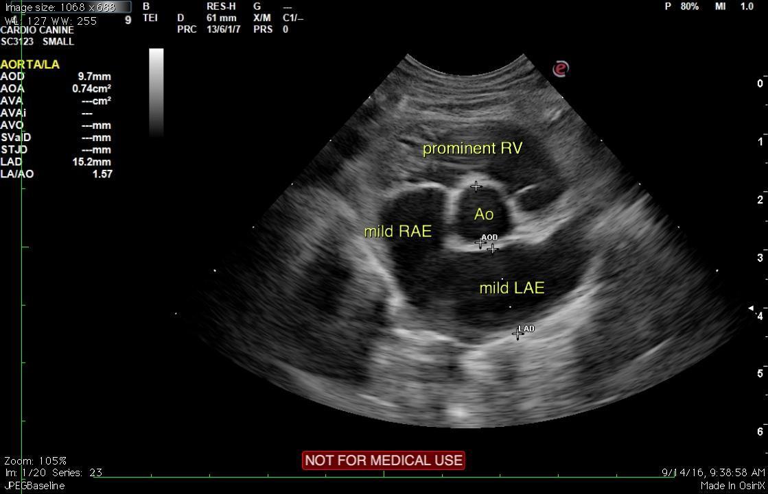 Mild restrictive cardiomyopathy (RCM) with mild biatrial enlargement in ...