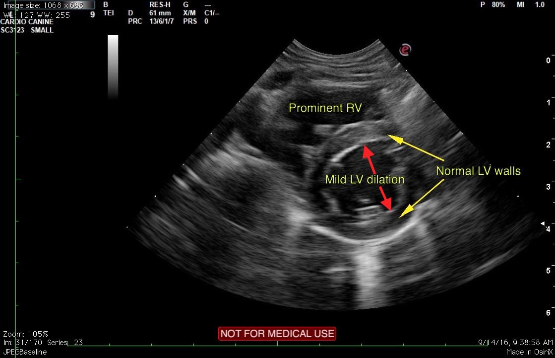 Mild restrictive cardiomyopathy (RCM) with mild biatrial enlargement in ...