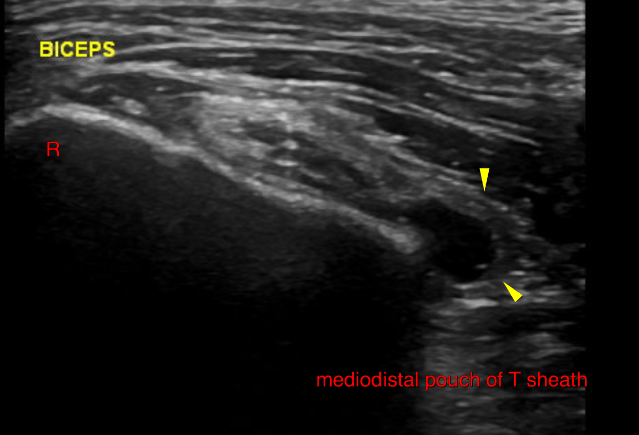 Ortho - Chronic Bilateral Tenosynovitis Of The Biceps Tendon Sheath In 