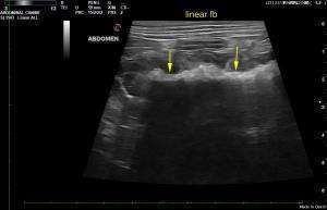GI Linear Fb with Intussusception in 12 yr Boston