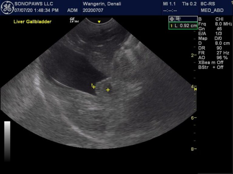 ct scan gallbladder polyp