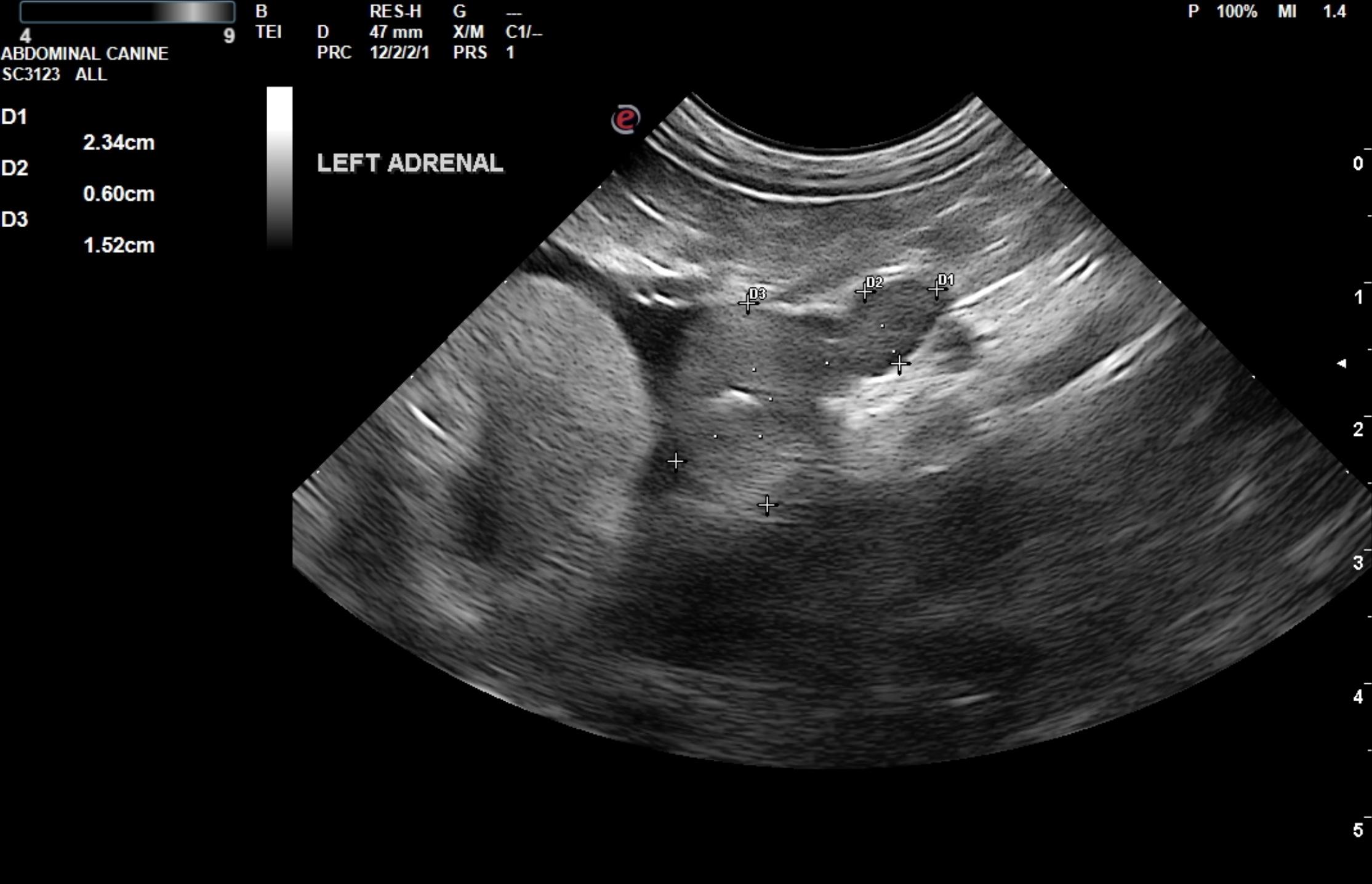 Right Adrenal Mass Invading The Vena Cava And Obstructing The Hepatic 