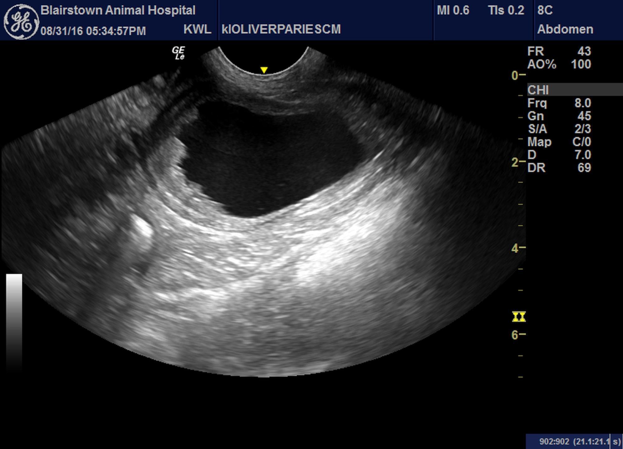 Perforated Gallbladder Mucocele and Polypoidal Urinary Bladder Changes ...